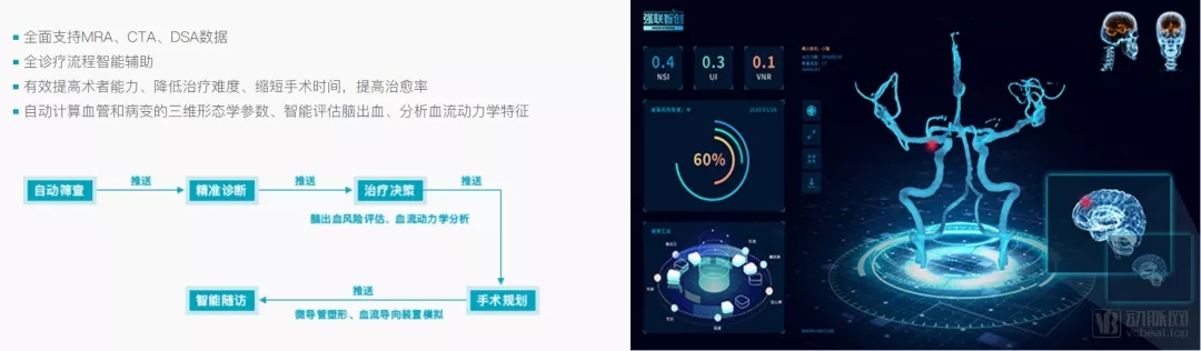 强联智创完成数千万元b轮融资,推进脑卒中全诊疗平台商业化落地